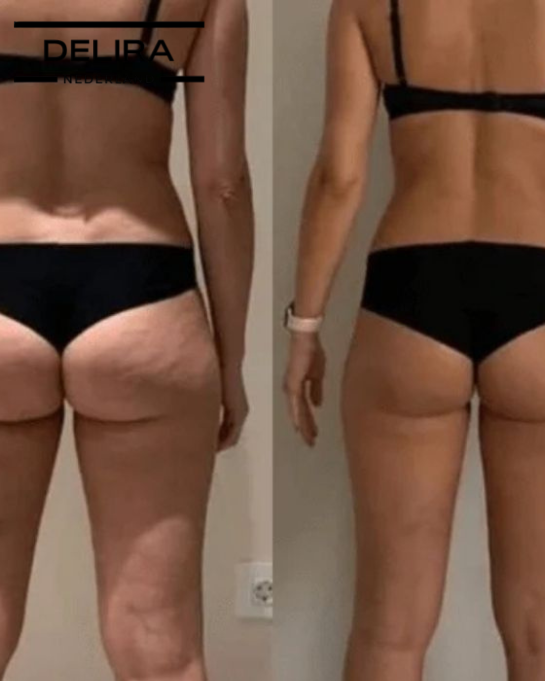 Siluva Pro™ – Verminder Cellulite & Verstevig Je Huid in Slechts 10 Minuten Per Dag!