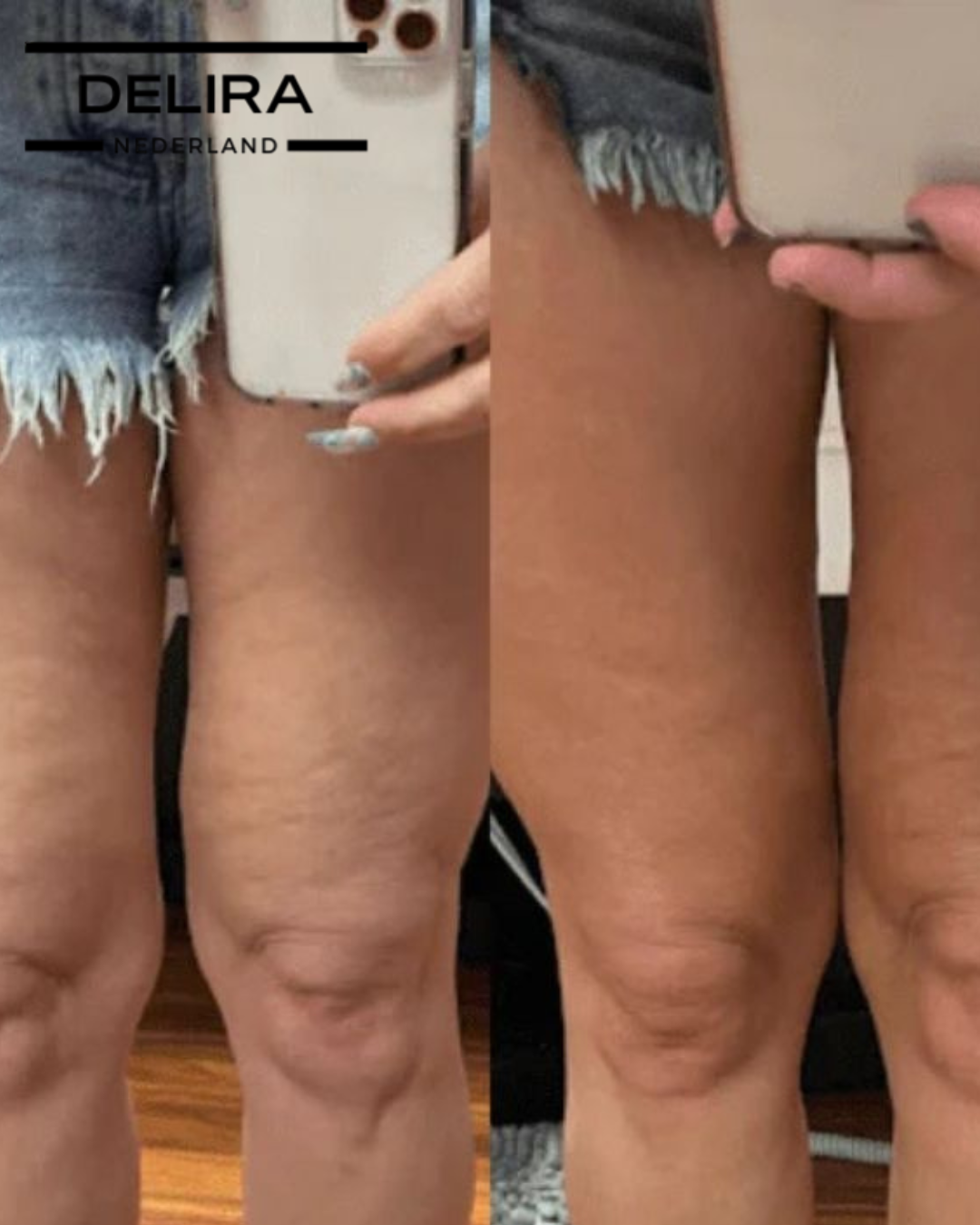 Siluva Pro™ – Verminder Cellulite & Verstevig Je Huid in Slechts 10 Minuten Per Dag!
